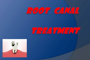 Root Canal